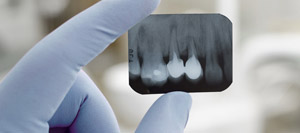 LANAP Laser Periodontal Therapy