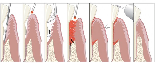 Laser Periodontal Therapy