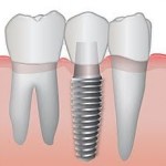 dental implant